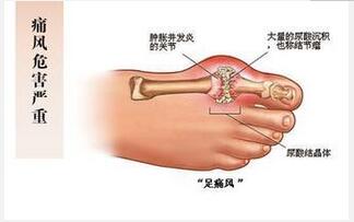 痛風病人吃什么好？ 飲食需合理搭配