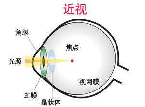 戴眼鏡會(huì)讓眼睛近視度數(shù)加深？