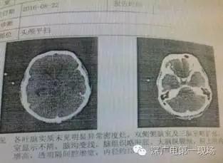 深圳男子被罕見(jiàn)“吃腦蟲(chóng)”侵入 十幾天后病逝