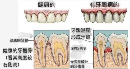 慎用牙簽？牙縫真的越剔越大嗎