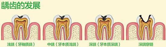 慎用牙簽？牙縫真的越剔越大嗎